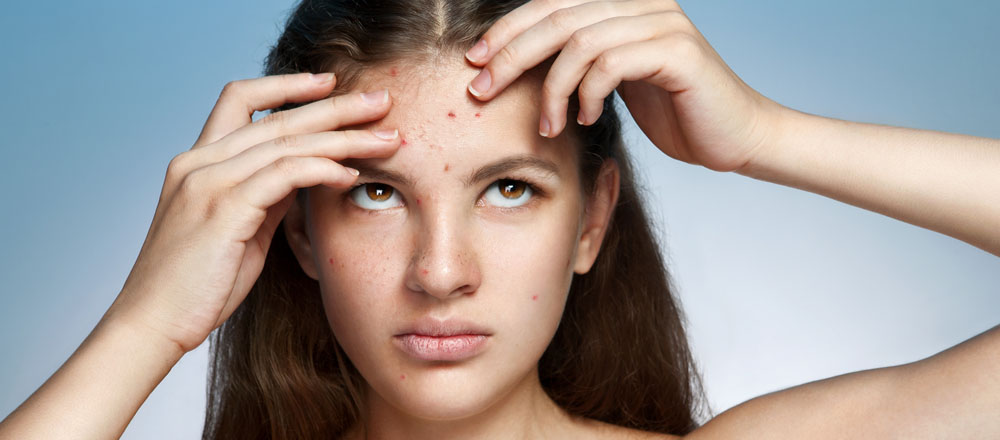 A young woman with acne